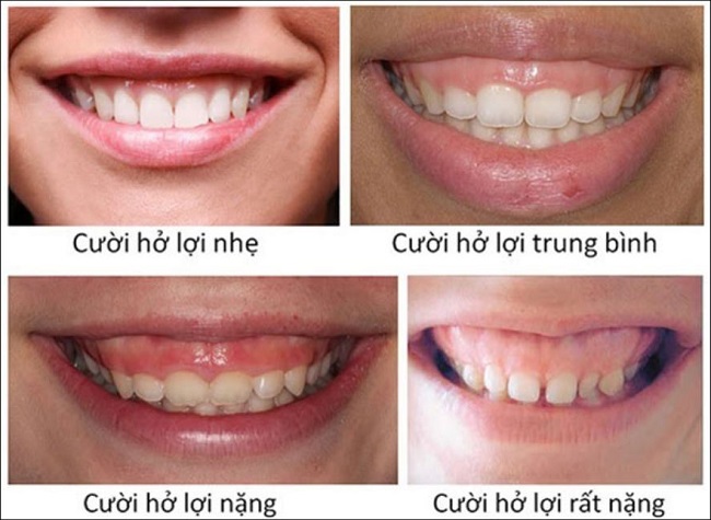 cuoi-ho-loi-la-gi1