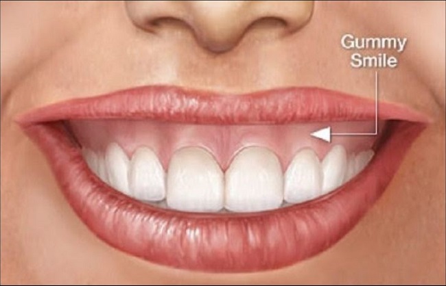 cuoi-ho-loi-la-gi2