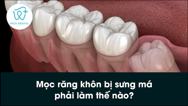 moc-rang-khon-bi-sung-ma-phai-lam-the-nao