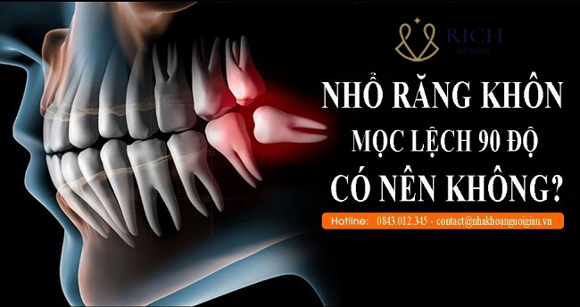 rang-khon-moc-lech-90-do-co-nen-nho-hay-khong