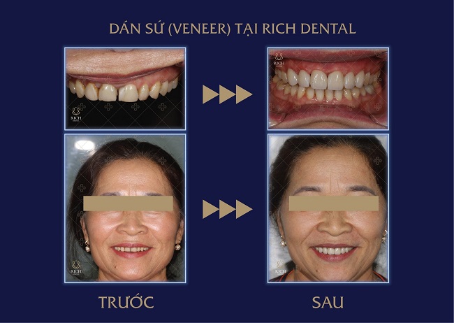 dan-rang-su-veneer-khong-mai-rang-gia-bao-nhieu