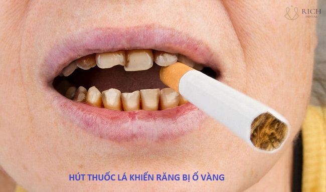 tẩy trắng răng ở hội an