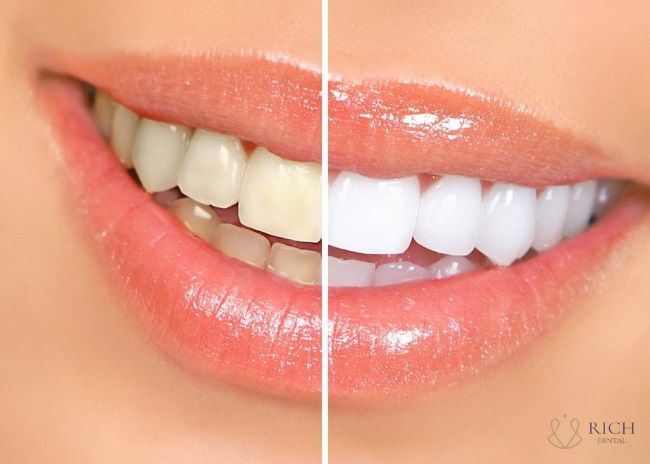 Tẩy trắng răng ở Hội An