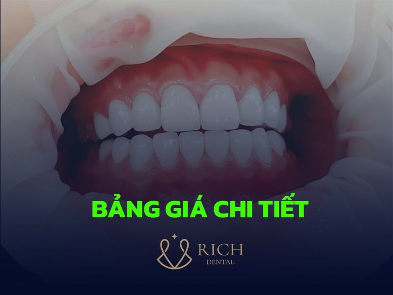 BANG-GIA-BOC-RANG-SU-NGUYEN-HAM