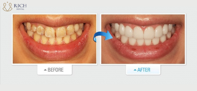 Hinh-anh-khach-hang-dan-su-veneer-tai-rich-dental