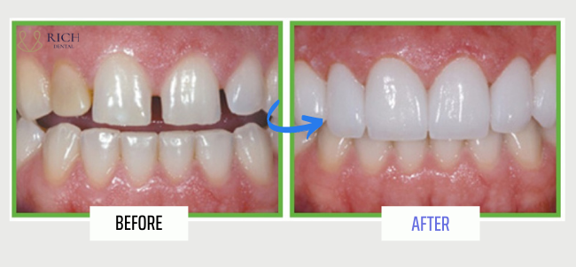 Hinh-anh-khach-hang-dan-su-veneer-tai-rich-dental
