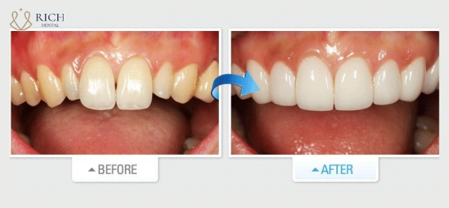 Hinh-anh-khach-hang-dan-su-veneer-tai-rich-dental