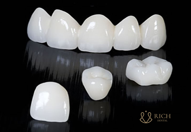 dan-su-Veneer-c0-may-loai