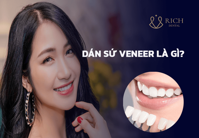 dan-su-veneer-kim cương