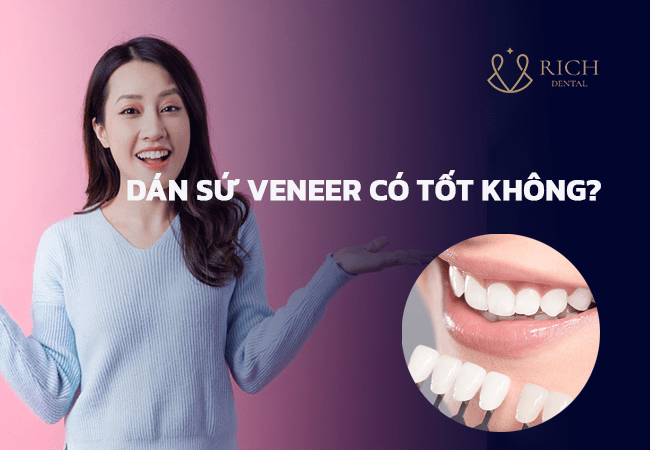 dan-su-veneer-kim cương