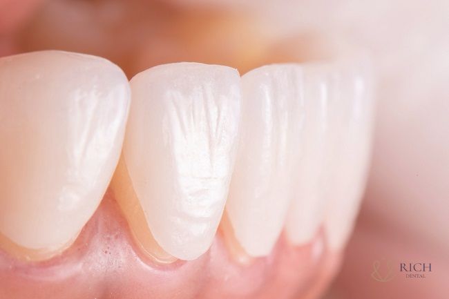 dan-su-veneer-tai-quang-ngai