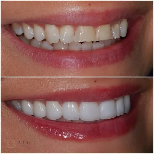 dan-su-veneer-tai-quang-ngai