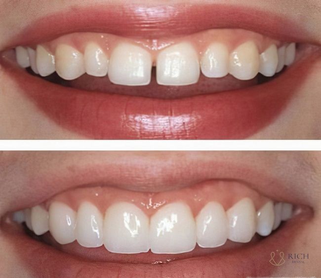 dan-su-veneer-tai-quang-ngai