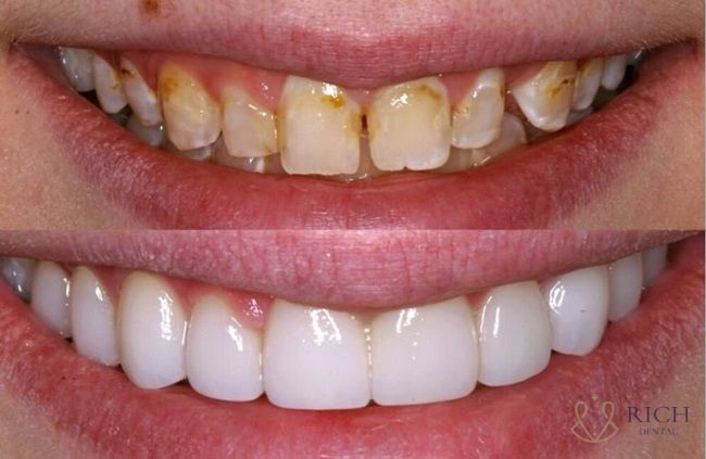 dan-su-veneer-tai-quang-ngai