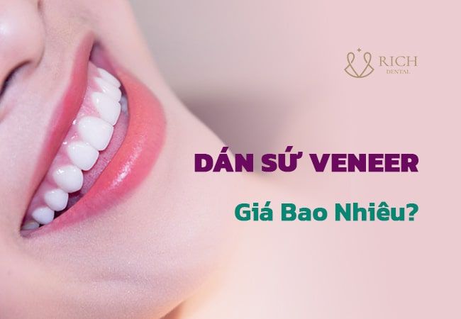 dan-su-veneer-tra-gop