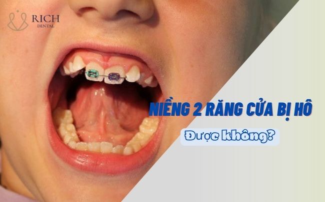 nieng-2-rang-cua-bi-ho-duoc-khong