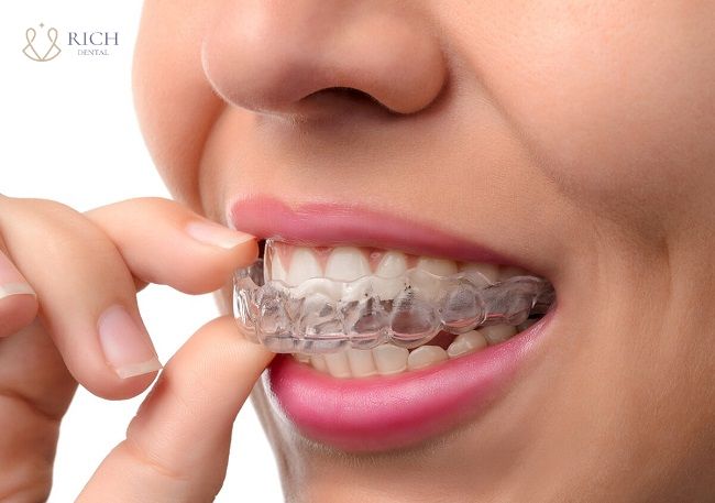 Mắc cài khi niềng răng hô nieng-rang-ho-nhe-mat-bao-lau
