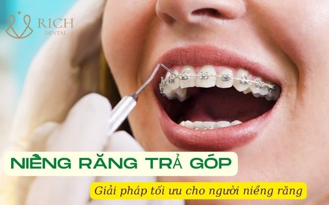 nieng-rang-tra-gop-la-gi