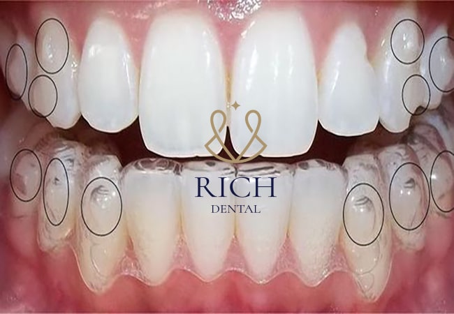 tẩy trắng răng máng tẩy tắng răng