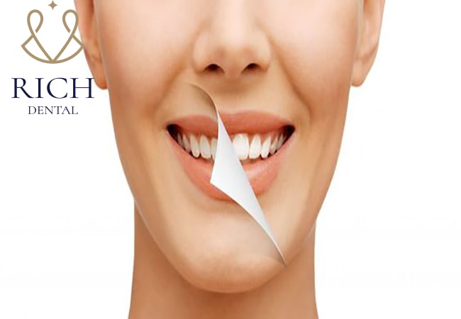tẩy trắng răng Các phương pháp tẩy trắng răng hiện nay