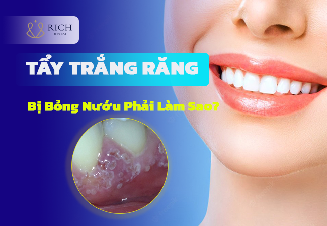 tay-trang-rang-bi-bong-nuou-phai-lam-sao