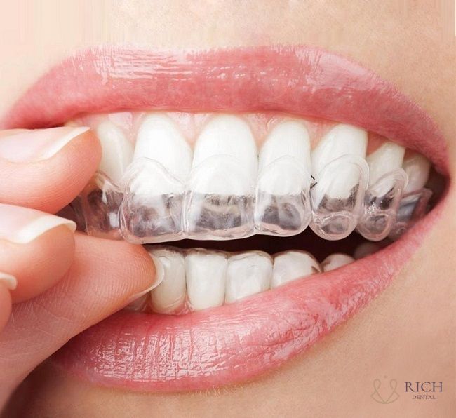 Tẩy trắng ẳng có bị vàng lại không tay-trang-rang-co-bi-vang-lai-khong
