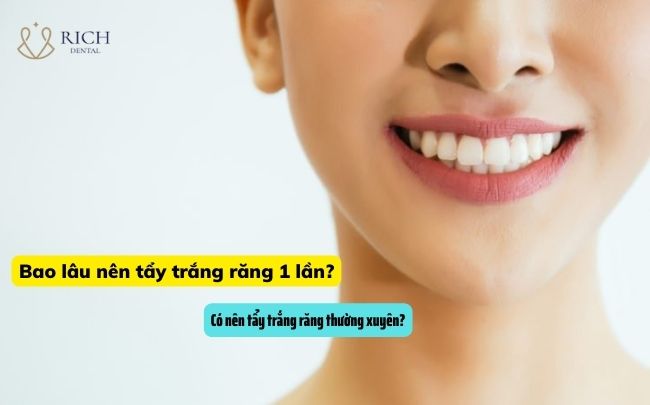 Tẩy Trắng Răng Duy Trì Được Bao Lâu bao-lau-nen-tay-trang-rang-1-lan