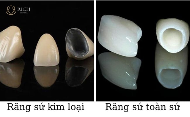 boc-rang-su-1-ham-bao-nhieu-tien
