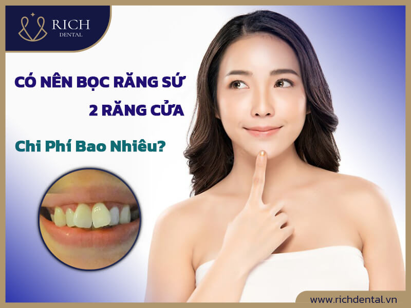 Bọc răng sứ 2 răng cửa