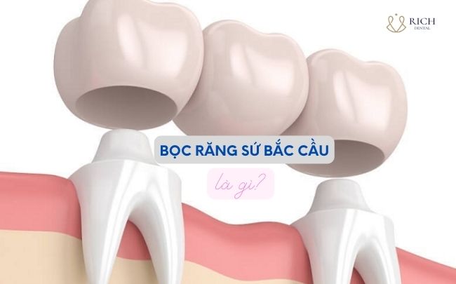 boc-rang-su-bac-cau-la-gi