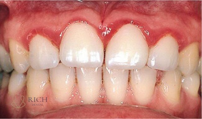 Bọc Răng Sứ Bị Nhiễm Trùng boc-rang-su-bi-nhiem-trung