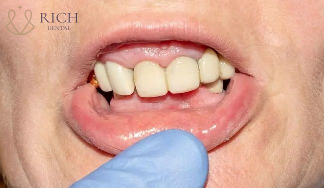 Bọc Răng Sứ Bị Nhiễm Trùng boc-rang-su-bi-nhiem-trung