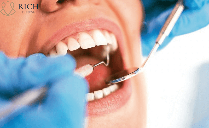 Bọc răng sứ zirconia Thăm khám theo lịch hẹn