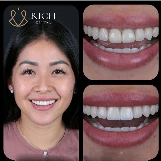 boc-rang-su-zirconia