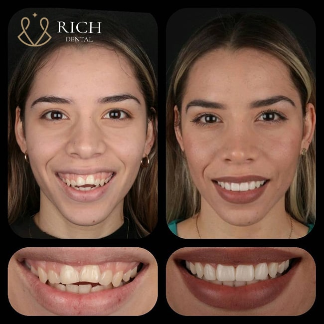 boc-rang-su-zirconia