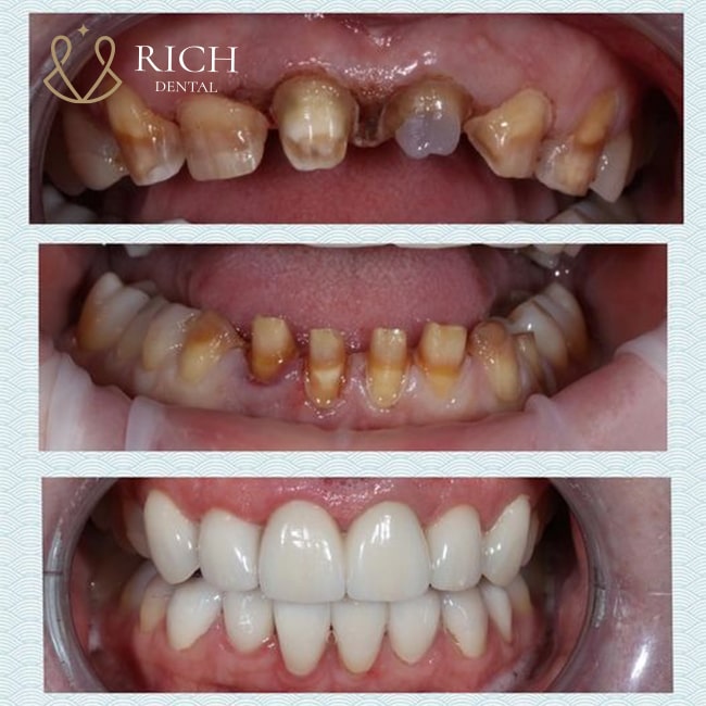 boc-rang-su-zirconia