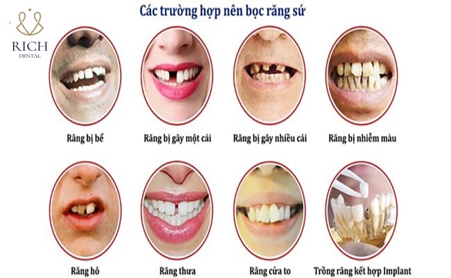 bọc sứ 16 răng