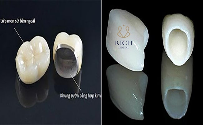 bọc sứ 16 răng