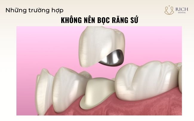 nhung-truong-hop-khong-nen-boc-rang-su