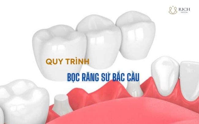 quy-trinh-boc-rang-su-bac-cau