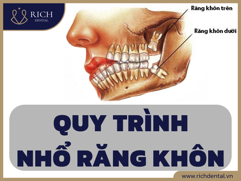 quy-trinh-nho-rang-khon