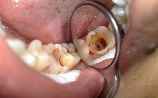 bọc sứ răng số 8 rang-so-8-bi-sau-vo