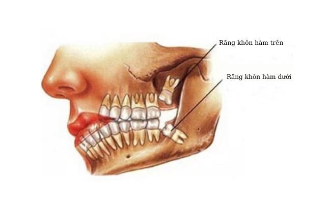 bọc sứ răng số 8 rang-so-8-la-rang-nao