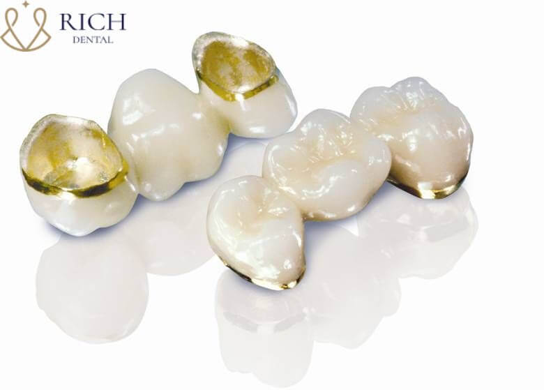 Răng sứ kim loại quý có cấu tạo gồm 2 phần.