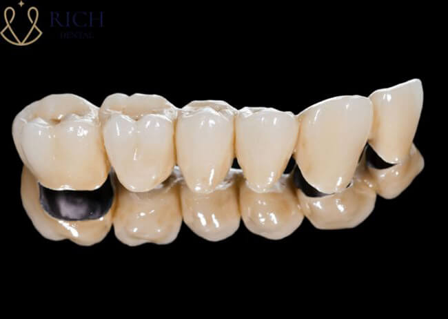 răng sứ titan và răng sứ zirconia Răng sứ Titan được chế tác từ chất Titanium 4 - 6%.