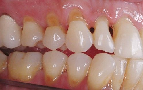 tẩy trắng răng bị tụt lợi