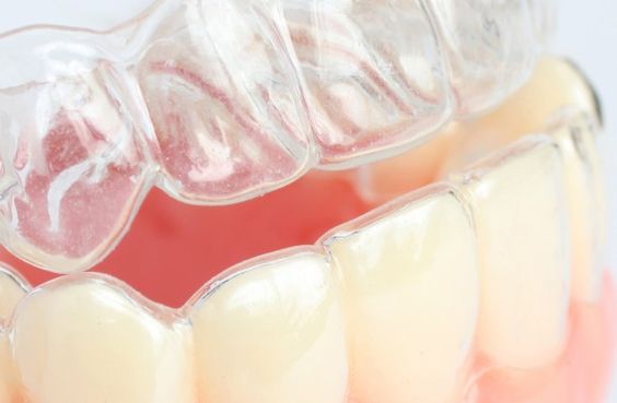 tẩy trắng răng bị tụt lợi