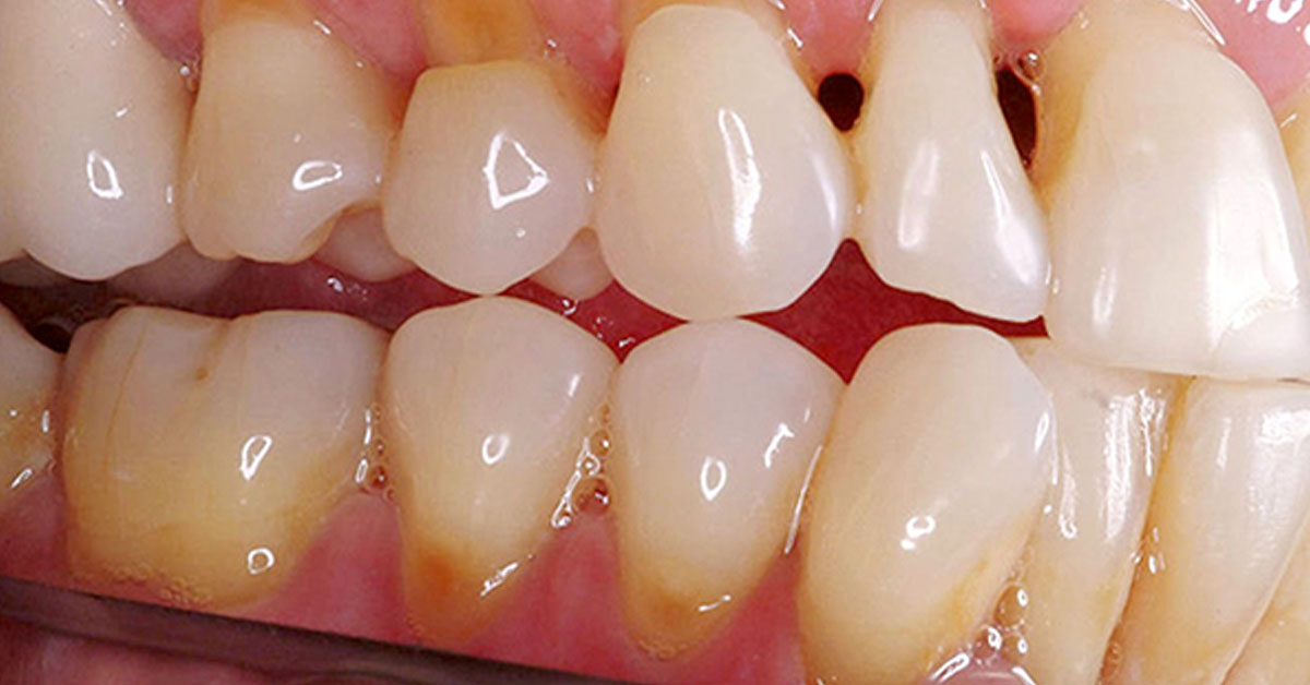 tẩy trắng răng bị tụt lợi