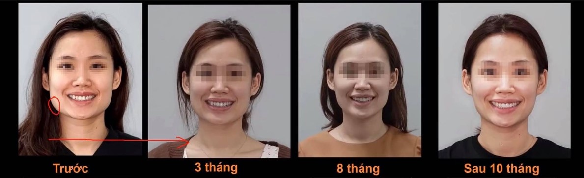 nieng-rang-co-hieu-qua-khong
