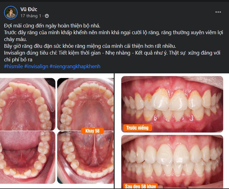 nieng-rang-co-hieu-qua-khong